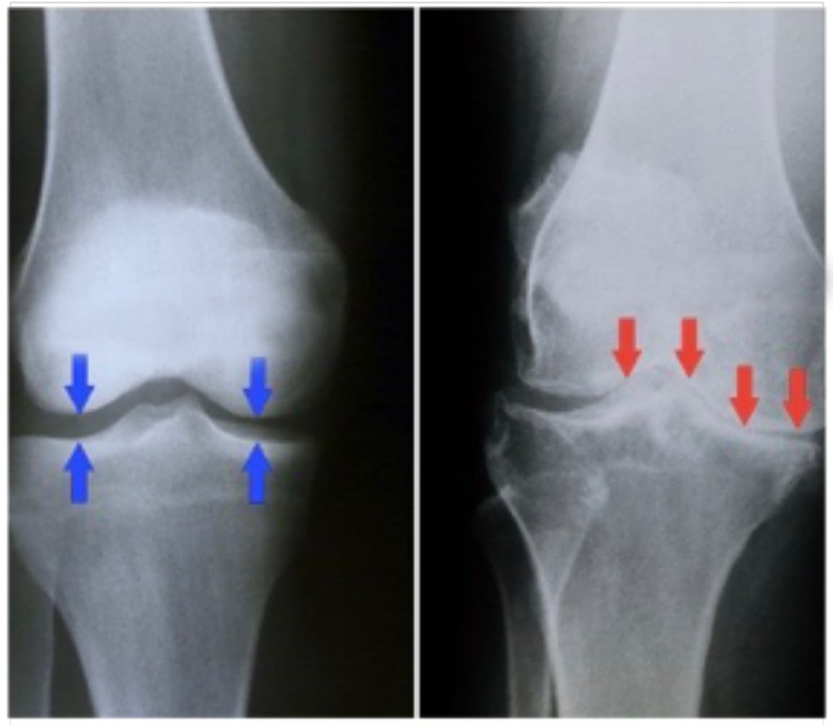 Artritis de rodilla - Artroscopia Rodilla