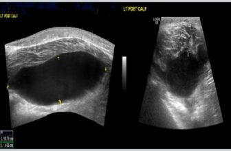 Infected Baker's cyste, diagnostisert i beredskapsavdelingen med POCUS