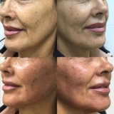 Envejecimiento Cutaneo