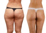 Combatir la Celulitis